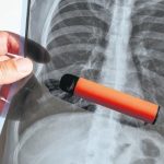 ‘Gitmeyen kilo’ değil, doğrudan hastalık! Milyonlarca kadında var, aynı bölgede yoğunlaşıyor